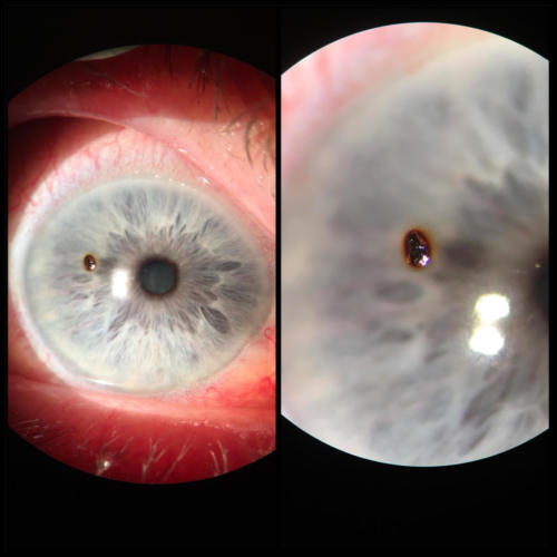 Corneal foreign body